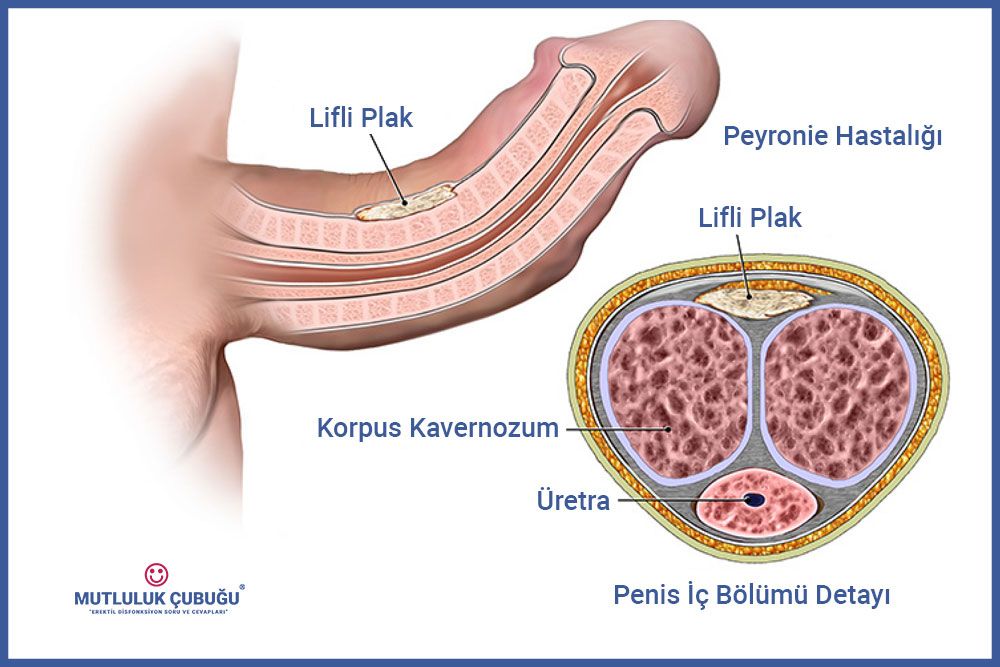 Peyronie Hastalığı (PH) Nedir